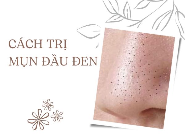 Nguyên nhân và cách trị mụn đầu đen tận gốc tại nhà