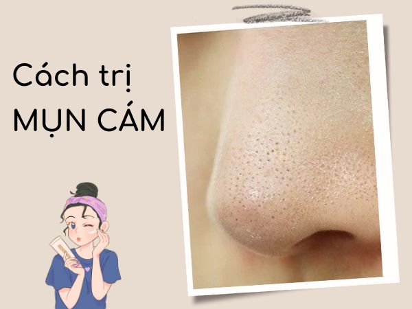 Khám phá các cách trị mụn cám giúp da trắng sáng không tì vết