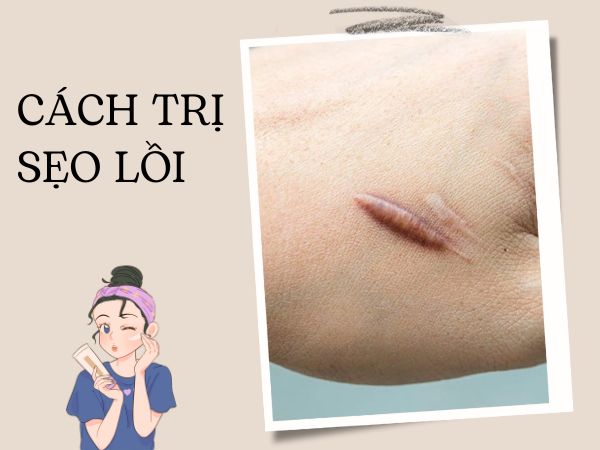 5+ cách trị sẹo lồi mới hình thành bằng nguyên liệu tự nhiên