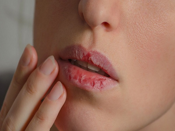 Cách trị khô môi tại nhà hiệu quả chị em không thể bỏ qua