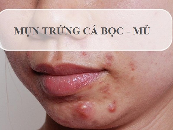 Top 5 cách trị mụn bọc tại nhà hiệu quả chị em nên thử