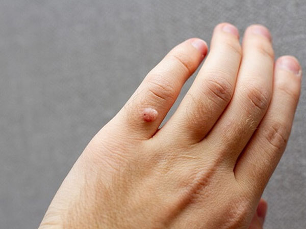 Mụn cóc là gì? Các cách trị mụn cóc tại nhà an toàn hiệu quả
