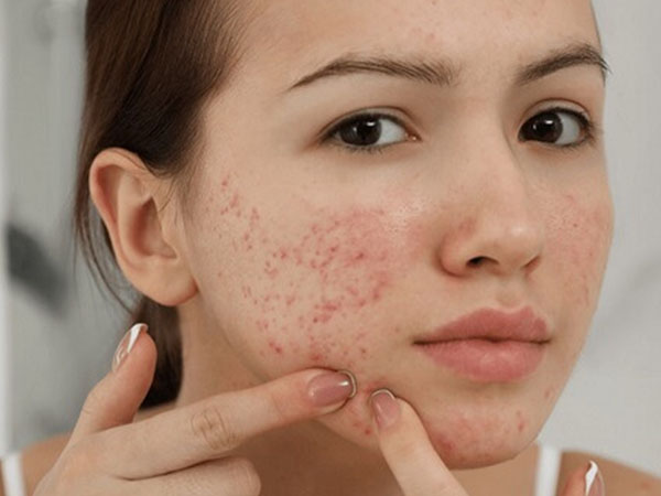 Tổng hợp các cách trị mụn trứng cá tại nhà hiệu quả nhất