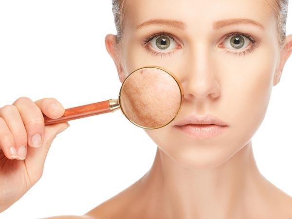 Mách bạn 5 loại mặt nạ trị nám cho hiệu quả tức thì