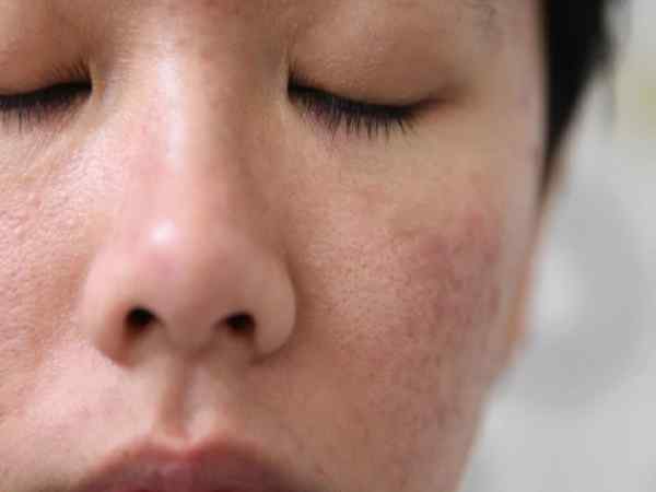 Cách chữa da mặt bị sần sùi