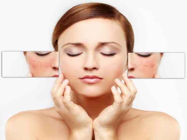Dấu hiệu và nguyên nhân khiến da bị nhiễm corticoid