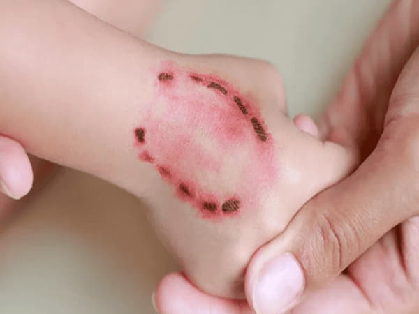 Bị chó cắn sau vài ngày có tiêm phòng được không?