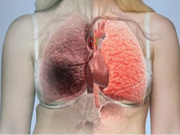 dấu hiệu ung thư phổi ở nữ giới