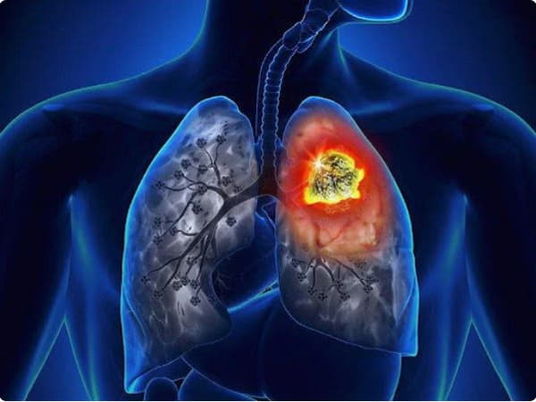 Dấu hiệu ung thư phổi ở nữ giới