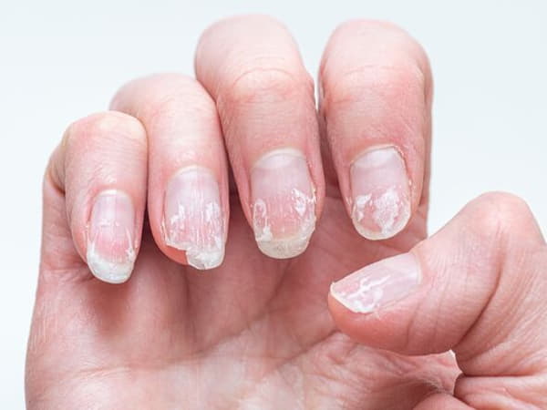 Những nguyên nhân khiến móng tay bị hư tổn