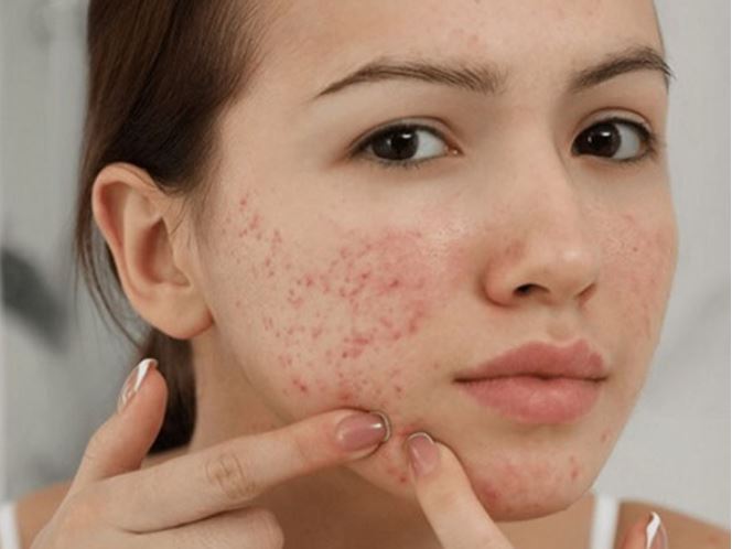 Mụn trứng cá, rậm lông, tăng cân bất thường