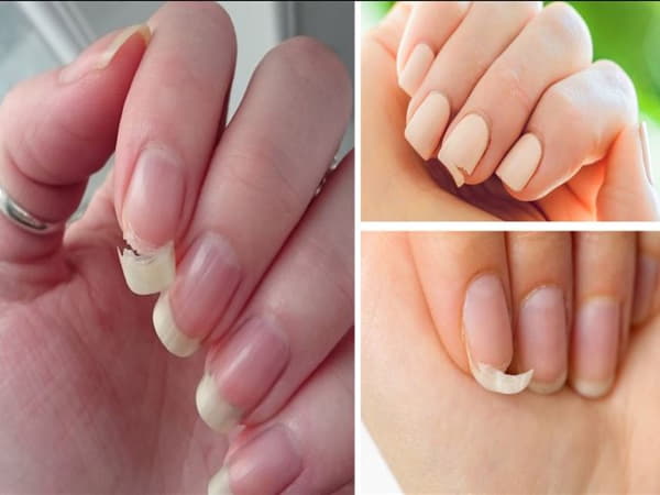 Nguyên nhân khiến móng tay chậm dài và dễ gãy